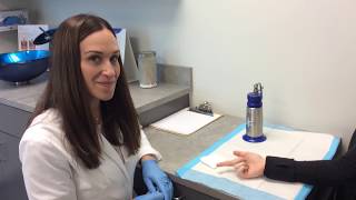 Wart Removal Using Liquid Nitrogen [upl. by Hairahcaz]