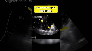 InterAtrial septal Aneurysm on Echocardiography echo heart [upl. by Yuri]