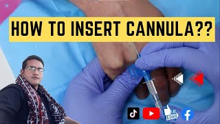 How to Insert IV Cannula  IV Cannulation Technique  Branula  Intravenous Catheter [upl. by Elijah]