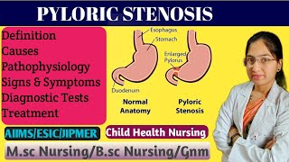 Pyloric Stenosis in Pediatric Nursing  Projectile Vomiting  Causes  Pathophysiology  Treatment [upl. by Shewchuk955]