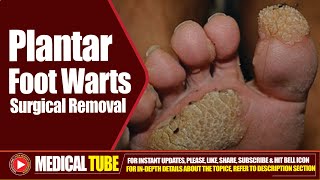 Foot Plantar Warts  Surgical Removal Treatment  How to Remove Plantar Warts ❌🦠 [upl. by Springer]