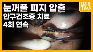 눈 피지 압출  안구건조증  눈꺼풀 염증 치료 [upl. by Oretna347]