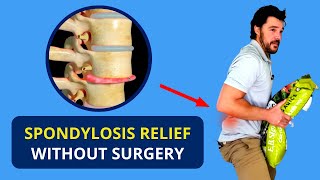 Spondylosis Treatment Without Surgery 🔥 Spondylolisthesis Causes [upl. by Wyatt517]