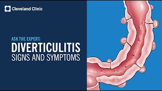 Warning Signs of Diverticulitis  Ask Cleveland Clinics Expert [upl. by Laing]