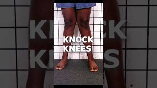 Knock Knees Hindi [upl. by Ozen]