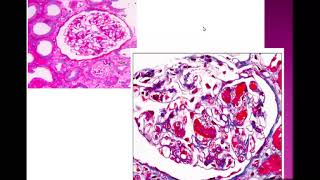 Thrombotic Microangiopathy part 1DrNoha Gamal [upl. by Santini]