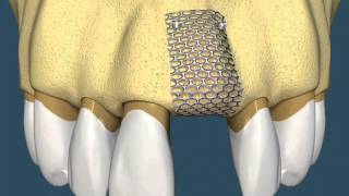 Implantes Dentários  Com Enxerto Ósseo [upl. by Thenna474]