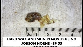 SKIN AND HARD EAR WAX REMOVAL USING JOBSON HORNE  EP 55 [upl. by Odlaner]