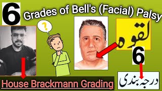 Grades of Bells Palsy Facial Palsy Laqwah I What is House Brackmann Scale I [upl. by Nekcerb]