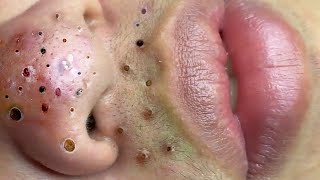 Treatment Of Blackheads And Hidden Acne 015 [upl. by Katzir7]