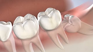 Wisdom Teeth Removal with Dr Seghi at Oral Surgery amp Dental Implant Specialists of Cincinnati [upl. by Asilram]