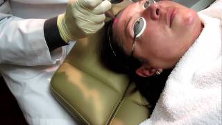 lite laser peel with fotona erbium laser [upl. by Gipson]