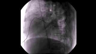 Pericardial aspiration under fluoroscopic guidance in lateral view [upl. by Elorak]