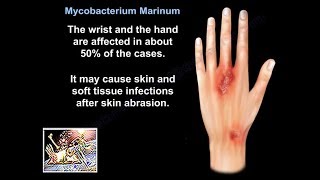 Mycobacterium Marinum  Everything You Need To Know  Dr Nabil Ebraheim [upl. by Alvan]