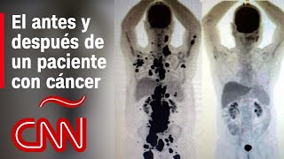 Antes y después de un paciente con cáncer que tuvo remisión en 1 mes gracias a terapia de células [upl. by Ydniw]