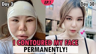 SUB Zygoma amp Jawline Reduction in Korea  vline facial bone surgery vlog review  Recovery Results [upl. by Htedirem437]