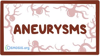 Aneurysms  causes symptoms diagnosis treatment pathology [upl. by Sosanna]