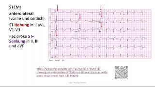 Herz 11 EKG 4  STEMI Perikarditis Extrasystole Kammerflimmern [upl. by Atiroc]