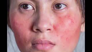 Beauty Tips Series Vol 2 9 Possible side effects of oral Isotretinoin in managing Acne [upl. by Thaddeus392]