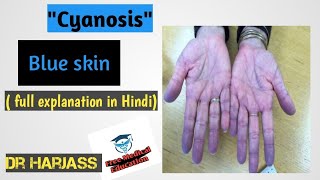 CyanosisBlue SkinFreeMedicalEducationld3sfCyanosismedicalnursingmbbsviralmedicalvideos [upl. by Johnson91]