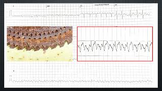 DIAGNOSTIC SIGN IN ECG  TALE OF TACHYCARDIA [upl. by Ydissac]