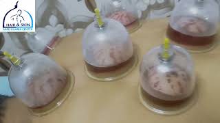 Full Hijama treatment review [upl. by Zetra686]