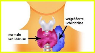 Hyperthyreose bei Frauen Symptome und empfohlene Nahrungsmittel [upl. by Adnirod]