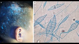 Tinea capitis bei Microsporum canis [upl. by Sirap]