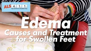 5 Ways to Get Rid of Edema [upl. by Lerrud384]