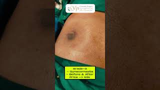 Transformative Results Grade3 Gynecomastia Before amp After  Procedure Benefits Confidence Boost [upl. by Worsham824]