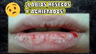 ¿LABIOS RESECOS Y AGRIETADOS  Tengo la solución [upl. by Romanas]