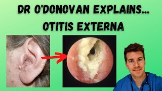 Explaining Otitis Externa  With Dr ODonovan [upl. by Oulman380]