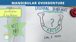 easy explanation of overdenture implant mandibular overdenture [upl. by Nemra]