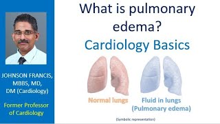 What is pulmonary edema Cardiology Basics [upl. by Sualokcin]