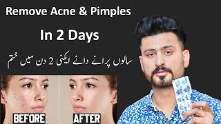 Best Treatment For Remove Pimple amp Acne In 2 Days  Pimples Removal Permanent On Face at Home [upl. by Airla]