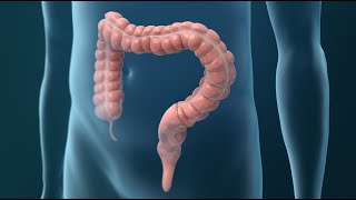 Treatments for Colorectal Cancer [upl. by Sorac]