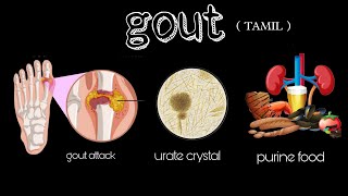 Pathophysiology of gout signs and symptomscausesrisk factorsand treatment in Tamil [upl. by Nodnar]