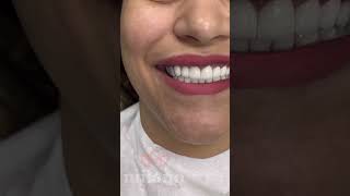 Emax Laminate Veneers in Turkey [upl. by Gilmore857]