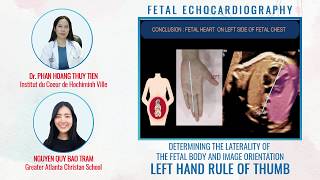 DETERMINING THE LATERALITY OF THE FETAL BODY  LEFT HAND RULE OF THUMB  FETAL ECHOCARDIOGRAPHY [upl. by Resiak306]