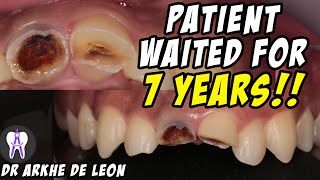 Amazing Case of Fractured Teeth Restored with Zirconia Crown 4k C29 [upl. by Araik526]