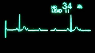 2nd Degree Atrioventricular Block Type II with 31 Block [upl. by Katheryn]