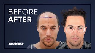 The fascinating change in our patient after his hair transplant surgery [upl. by Aldred]