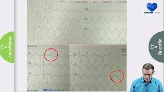 Taquicardia de QRS Largo e Criterios de Brugada [upl. by Bara585]