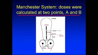 Brachytherapy 2 [upl. by Charpentier]