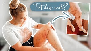 15 WOCHEN NACH Lipödem OP Update – Alles tut weh 😅 Vlog [upl. by Nilhtac]