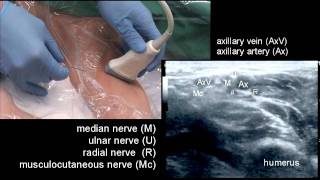 The Axillary Block [upl. by Llirret]