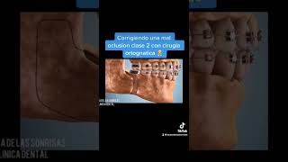 Corrigiendo una maloclusion clase 2 con cirugía ortognatica 👨‍⚕️ shorts [upl. by Nolitta]