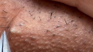 INGROWN HAIR REMOVAL 102  Longest Plucking Video Yet  DermaplaningEyebrow Shaving [upl. by Nomit]