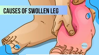 Causes of leg swelling DVTCELLULITISGANGRENELYMPHEDEMA amp more  Medicotes [upl. by Yespmed118]