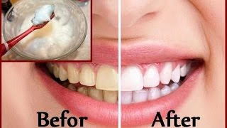 DIY Teeth Whitening at Home in 2 minutes [upl. by Liagabba144]